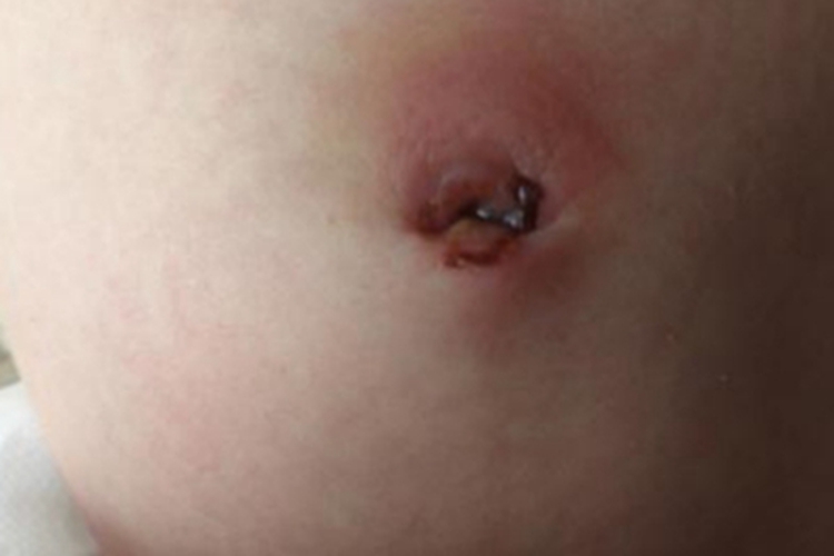 脐炎肚脐黑痂图 脐炎肚脐黑痂图