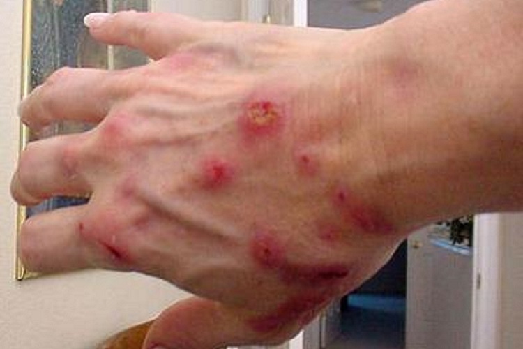 莱姆病手背症状图 莱姆病手背症状图