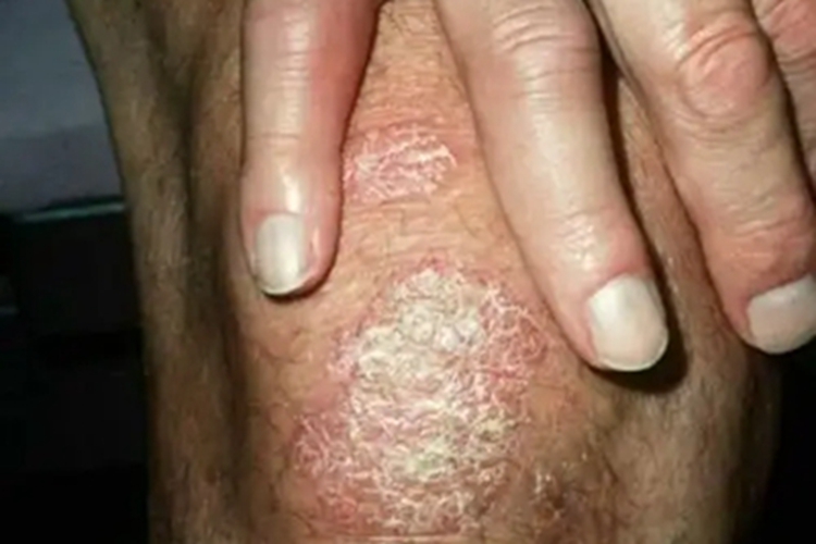 苔藓样型副银屑病膝盖丘疹图