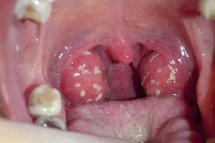 扁桃体炎扁桃体脓包图