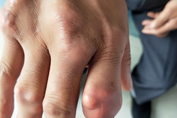 痛风手指有大小不一的肿块图 痛风手指有大小不一的肿块图