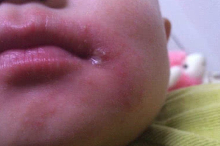 接触性口角炎口周红肿图 接触性口角炎口周红肿图