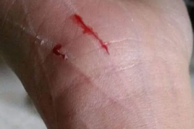 指甲抓痕渗血图