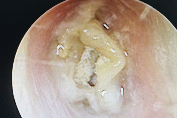 耳朵内长肉芽很严重吗图片