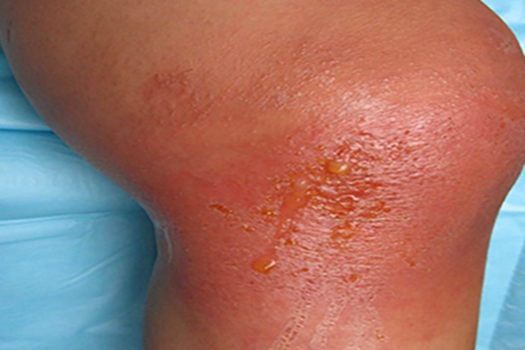 急性湿疹膝盖有水疱流黄水图