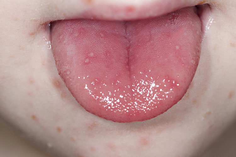 口腔黏膜轻微疱疹图