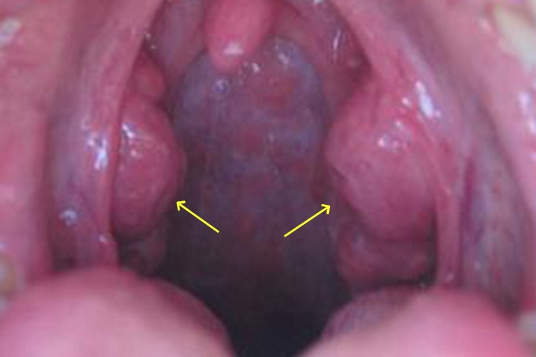 扁桃体不规则增生图 扁桃体不规则增生图