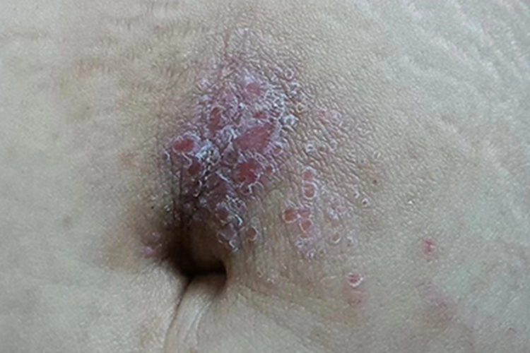 过敏性皮炎腹部脱皮图