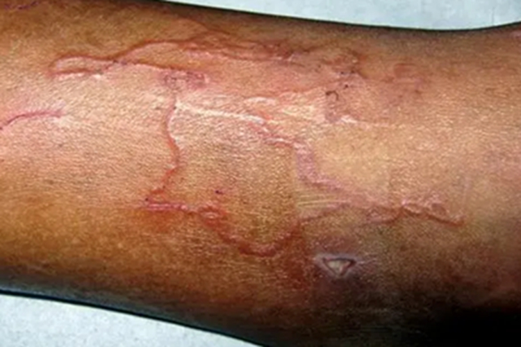 皮肤幼虫移行症小腿症状图