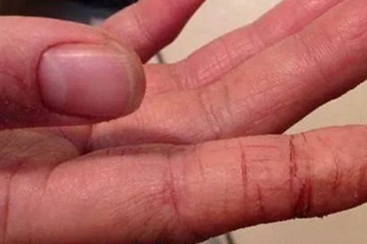 手足皲裂手指粗糙裂口图 手足皲裂手指粗糙裂口图