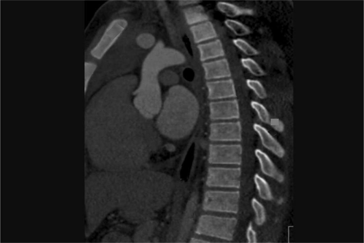 胸椎CT图 胸椎CT图