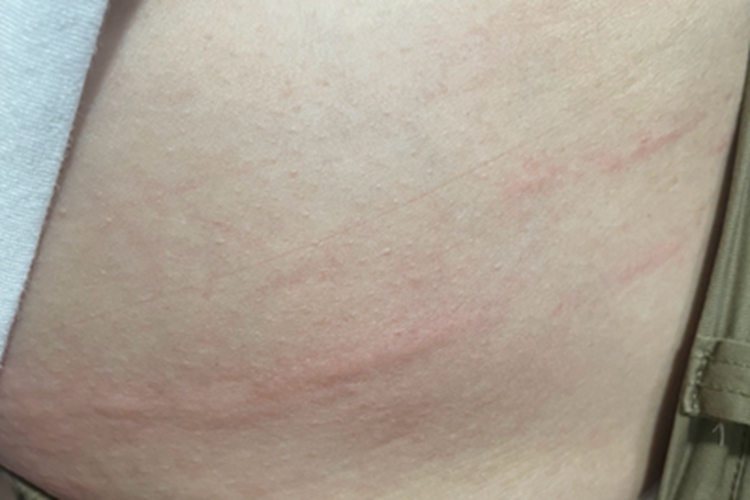 人工荨麻疹腹部症状图 人工荨麻疹腹部症状图