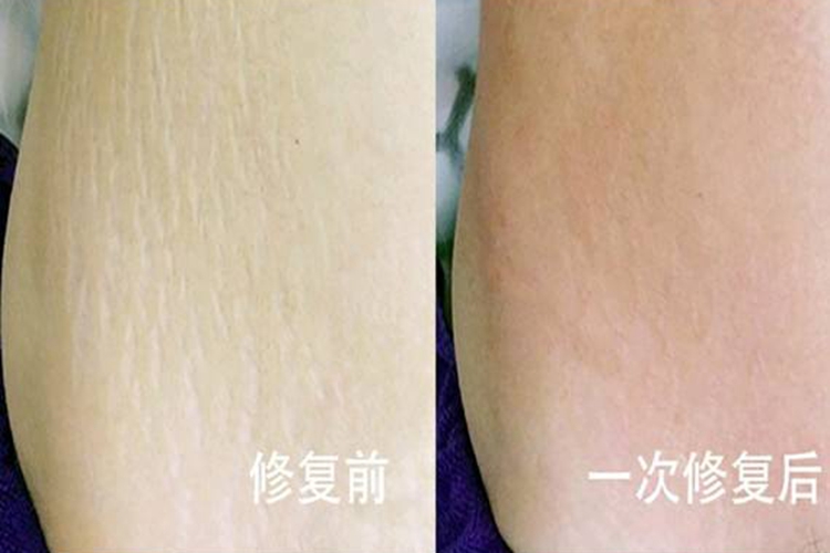 妊娠纹修复效果图