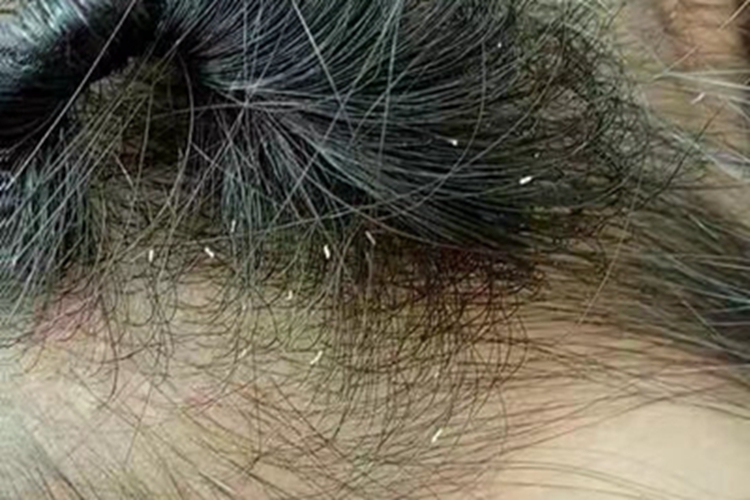 蠕形螨病头发鳞屑图