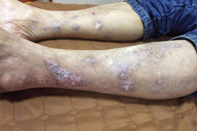 大疱性表皮松解症腿脱屑图 大疱性表皮松解症腿脱屑图
