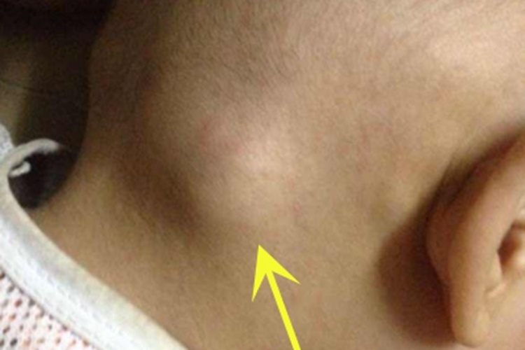 风疹枕后症状图