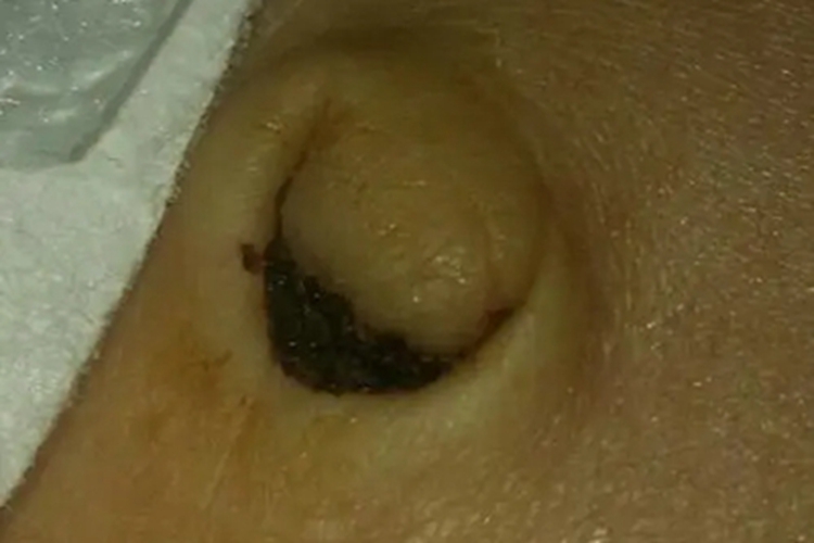 小儿脐疝肚脐黑痂图