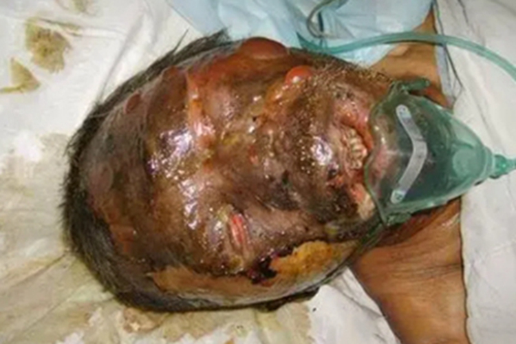 深Ⅱ度烧伤面部水疱图