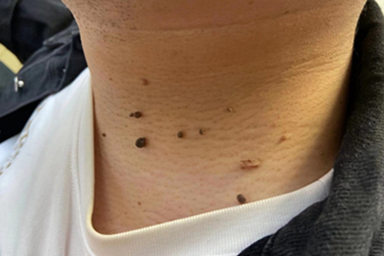 软纤维瘤肉粒图