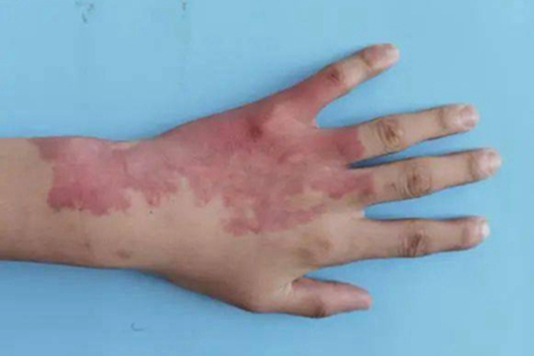 上皮样血管瘤手部红斑图