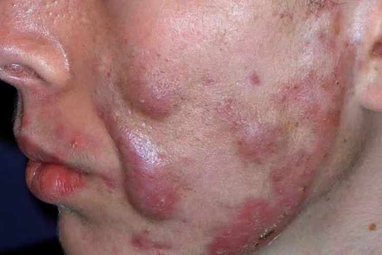 聚合型痤疮图