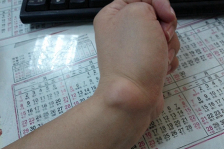 毛发囊肿手部囊肿图 毛发囊肿手部囊肿图