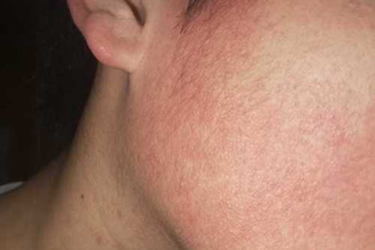 面部萎缩性毛周角化病面部丘疹图