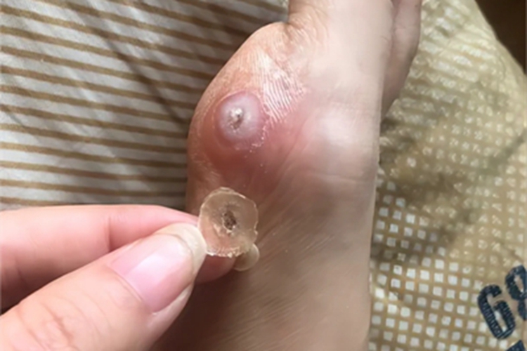 寻常疣脚部大疙瘩图 寻常疣脚部大疙瘩图