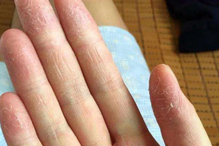 急性维生素A过多症手指尖脱皮图