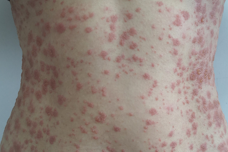 儿童药疹皮损图