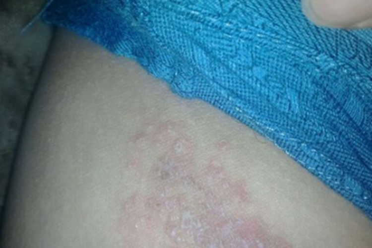 股癣大腿根起红疙瘩图