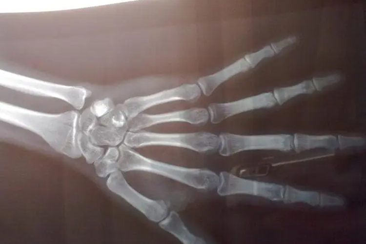 手腕骨骺线闭合图