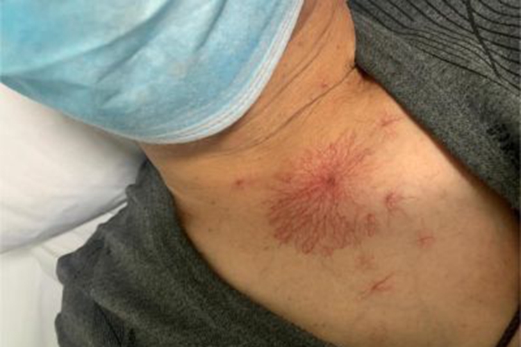 肝硬化前胸蜘蛛痣图