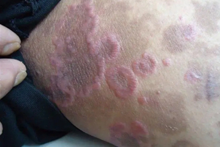 光线性扁平苔藓大腿症状图