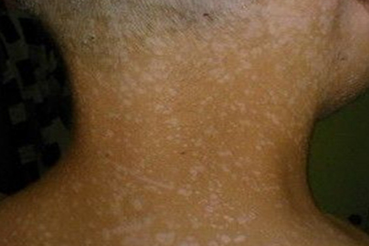 脖子上花斑癣出现密集白色点状皮损图