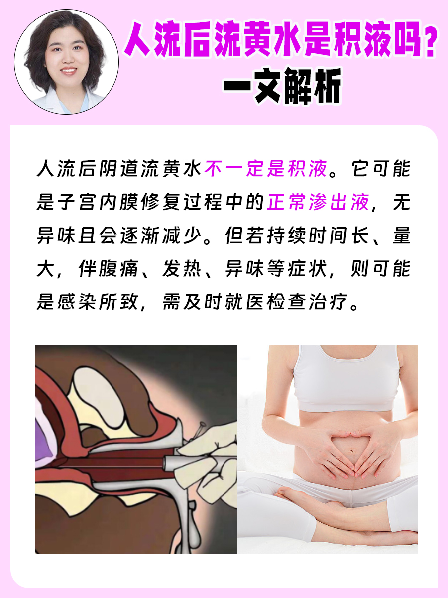 人流后流黄水是积液吗？一文解析