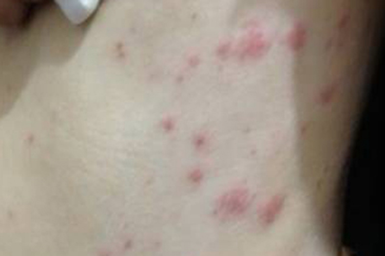 急性湿疹腰部症状图 急性湿疹腰部症状图