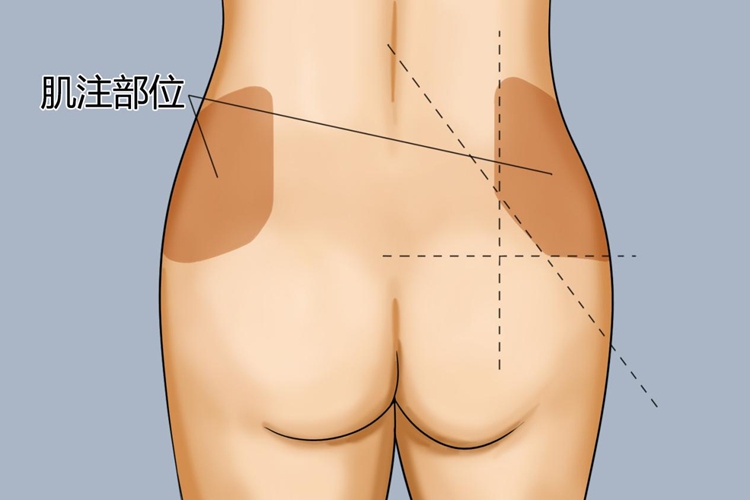 臀大肌注射位置图
