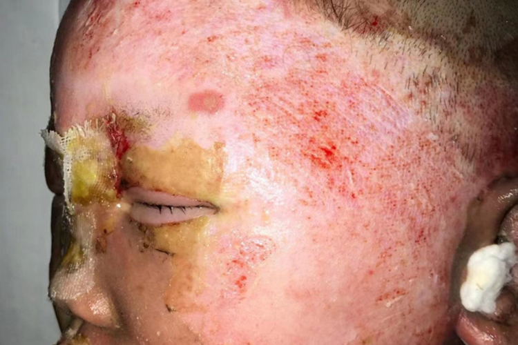 脸深Ⅱ度烧伤图