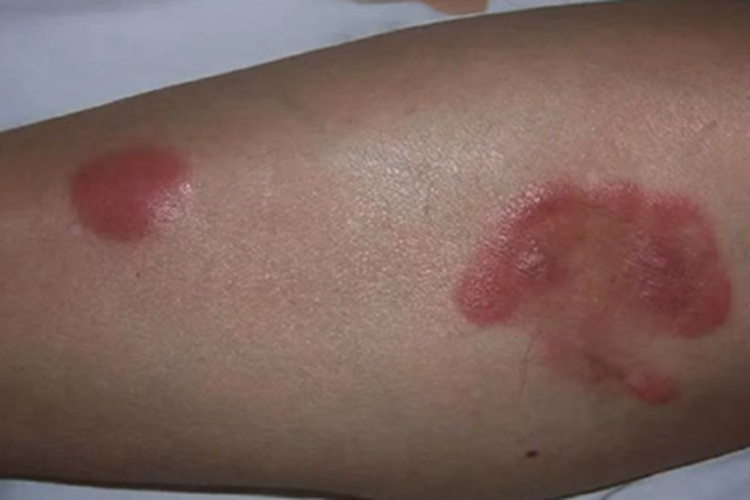 小螺菌型鼠咬热小腿症状图