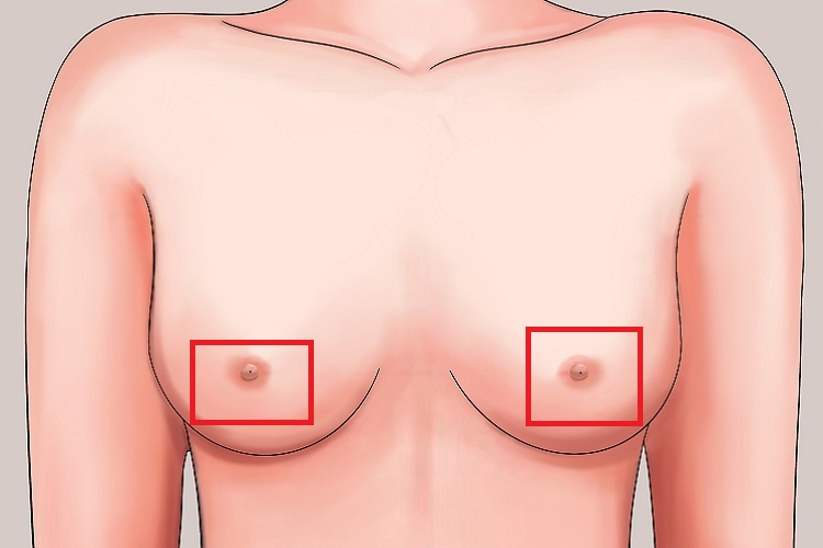 乳头半球状皮脂腺囊肿图 乳头半球状皮脂腺囊肿图