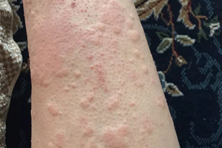 皮肤过敏红肿小腿疙瘩图 皮肤过敏红肿小腿疙瘩图