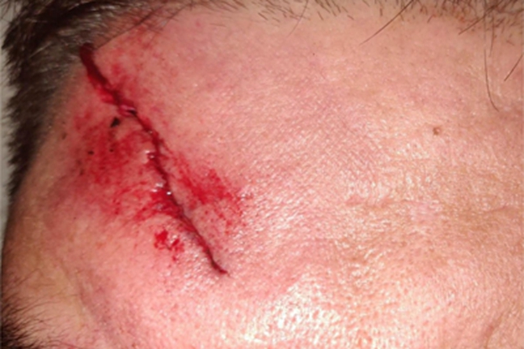 裂伤前额症状图 裂伤前额症状图