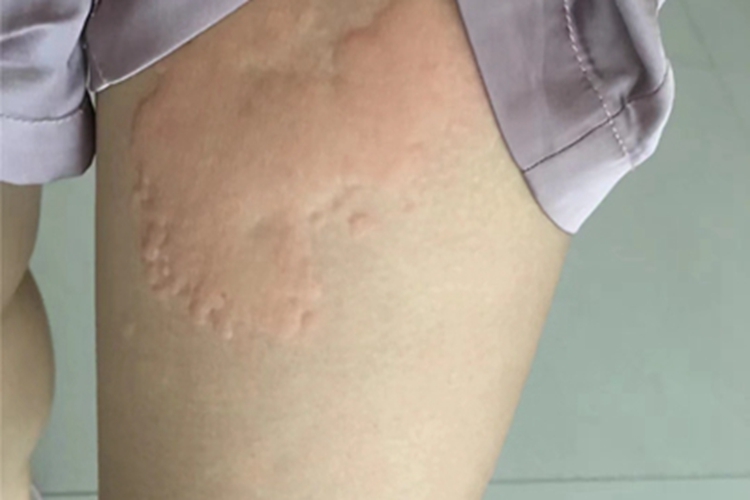 荨麻疹型药疹大腿症状图