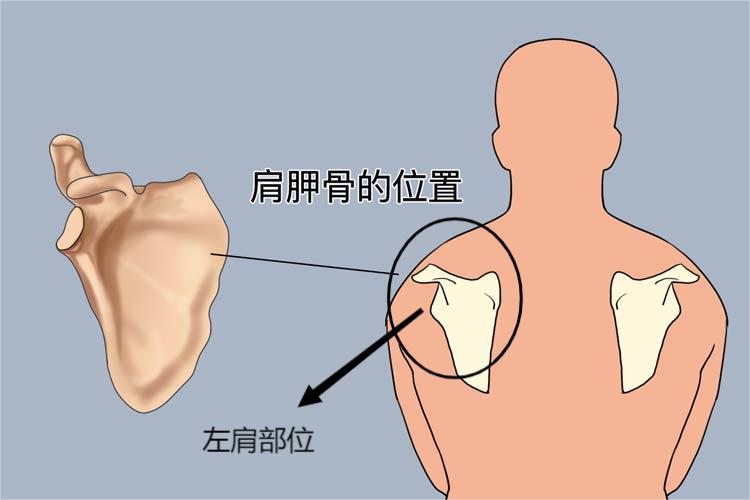 心梗后背痛的位置图 心梗后背痛的位置图