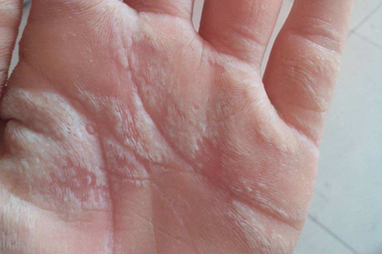 更年期角皮症手掌丘疹图