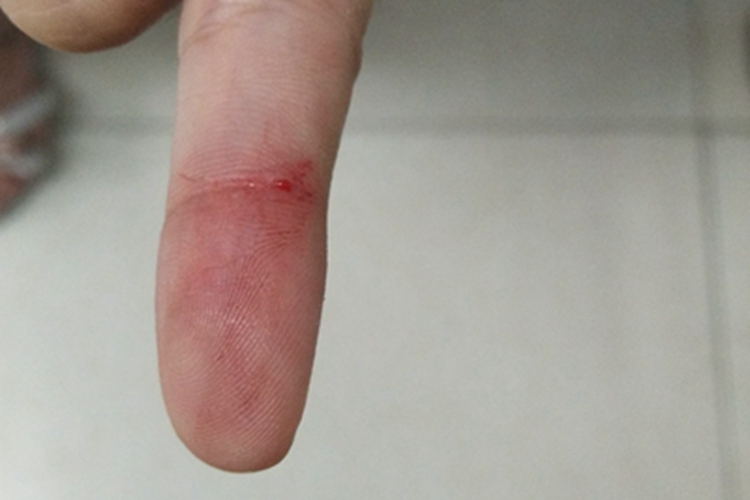 划伤手指症状图