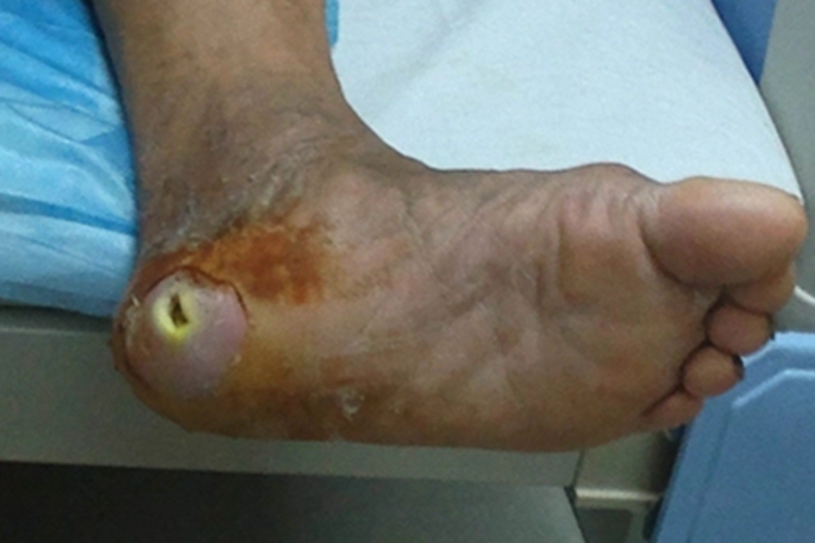 湿性坏疽脚后跟症状图 湿性坏疽脚后跟症状图