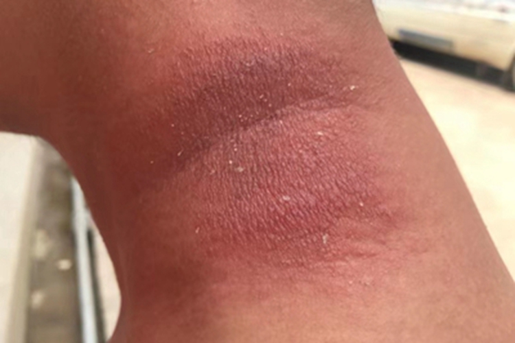 隐翅虫皮炎侧颈红斑脱屑图