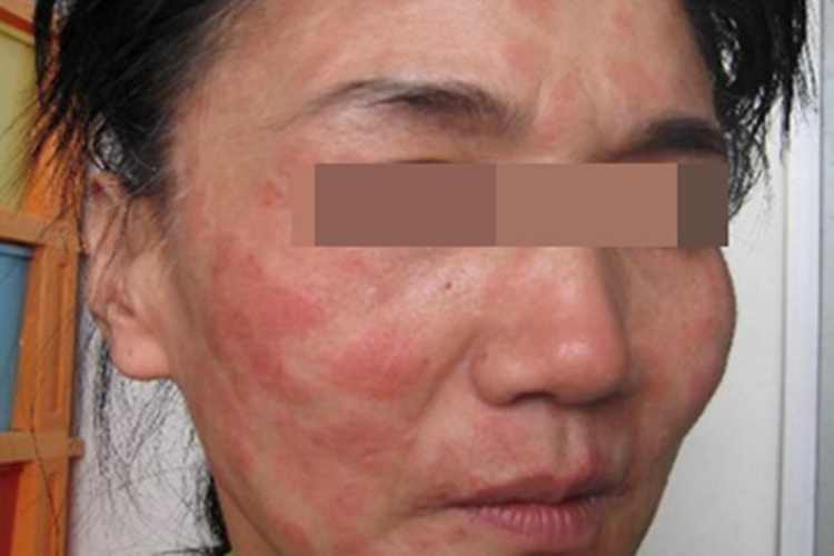 可变性红斑角化病凹凸不平图 可变性红斑角化病凹凸不平图